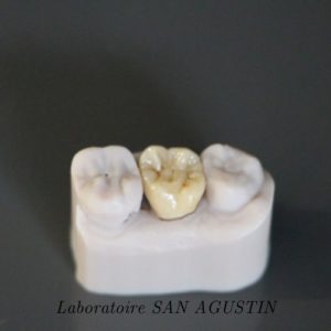 Couronnes zircone multicouches Laboratoire San Agustin